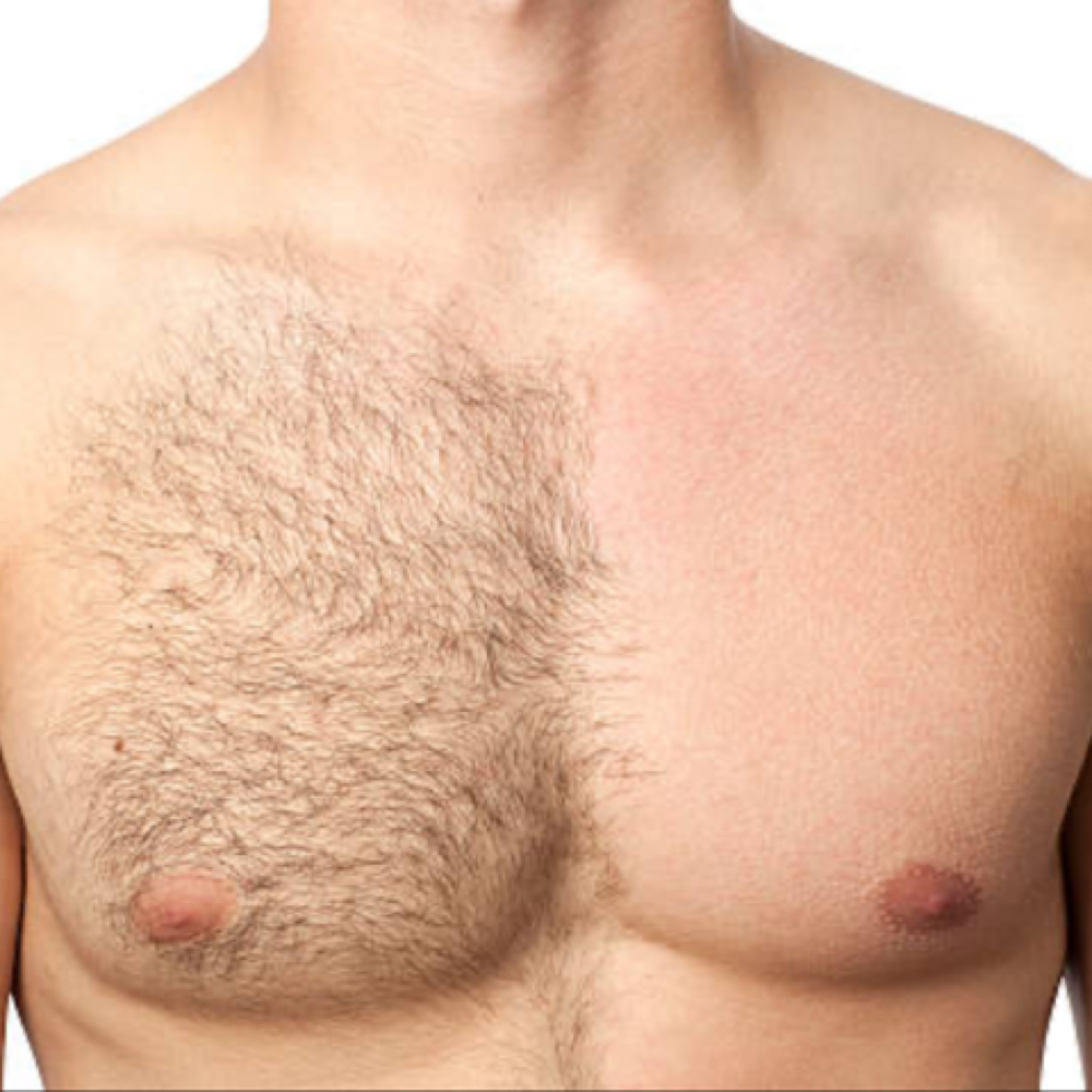 Laser Hair Removal (Large) 1tx