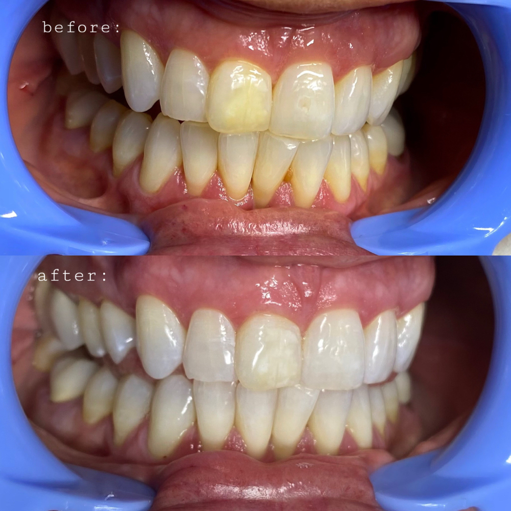 Organic Teeth Whitening