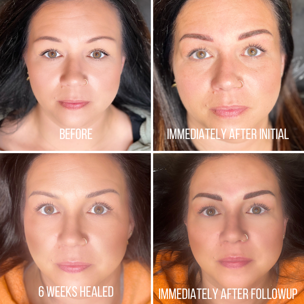 Followup between 8 wks & 11 months