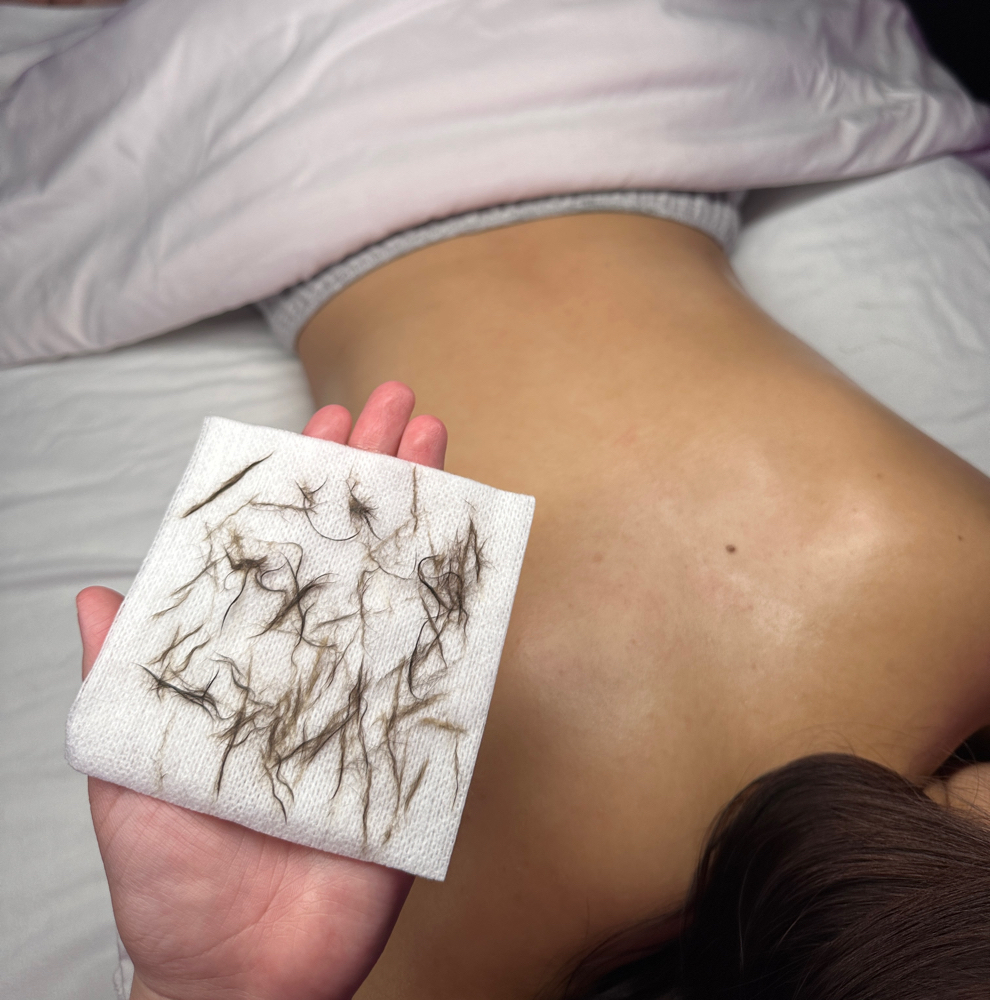 Dermaplane (Back Treatment-Add On)