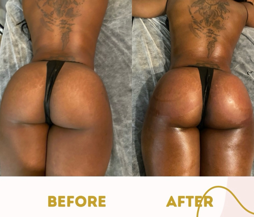 Non-surgical Butt Lift