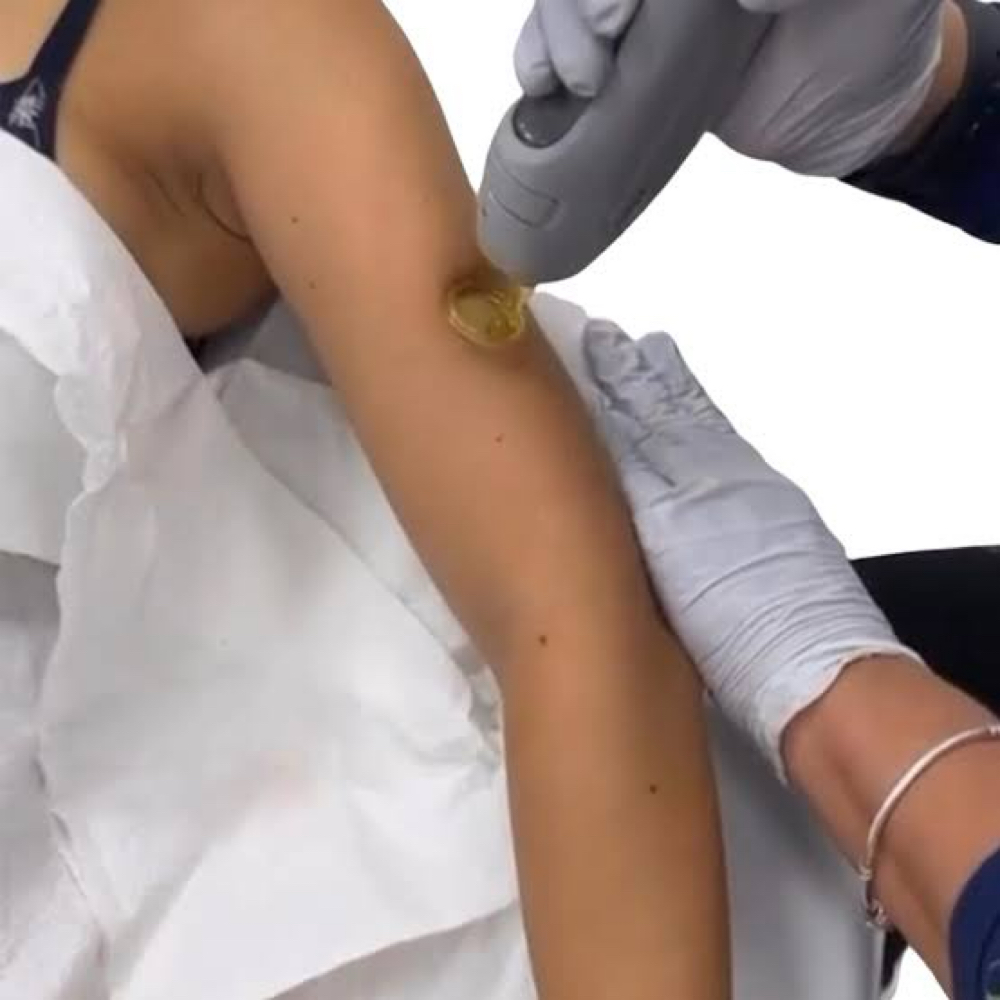 Laser Hair Removal- Full Arms at Chatuge Med Spa & Fitness in Hiawassee, GA