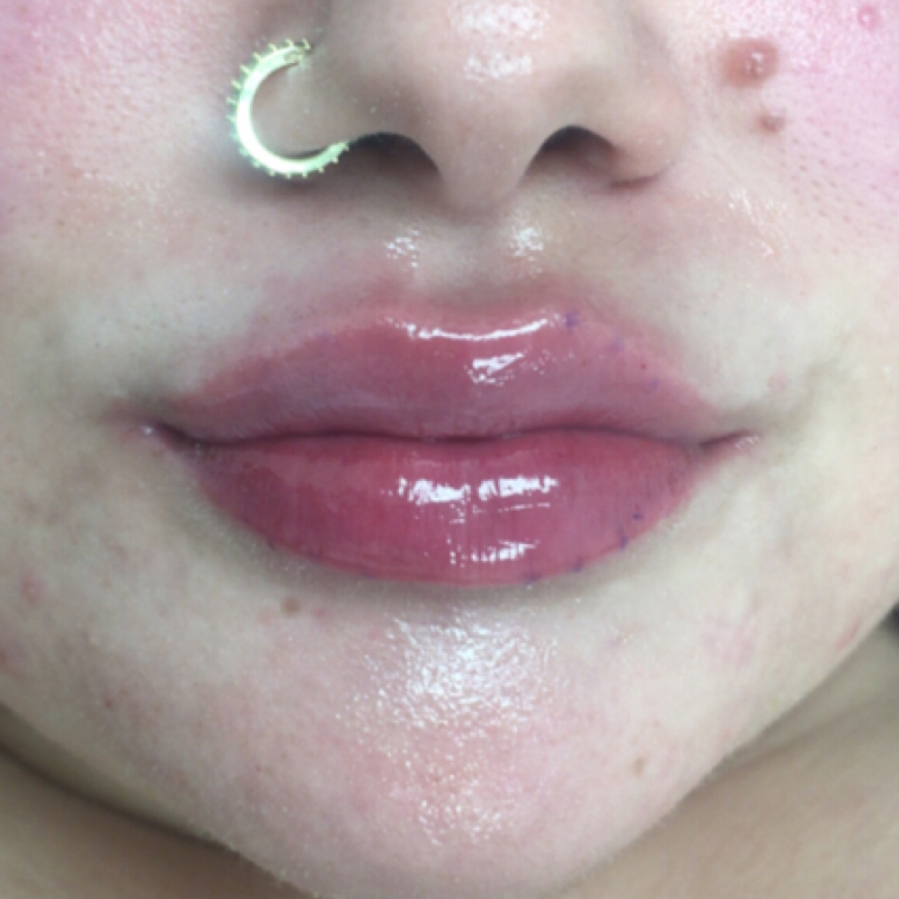 2 Full Syringe Lip Filler ✨💋 at DopeGirlz Beauty Spa Academy in Columbus, OH