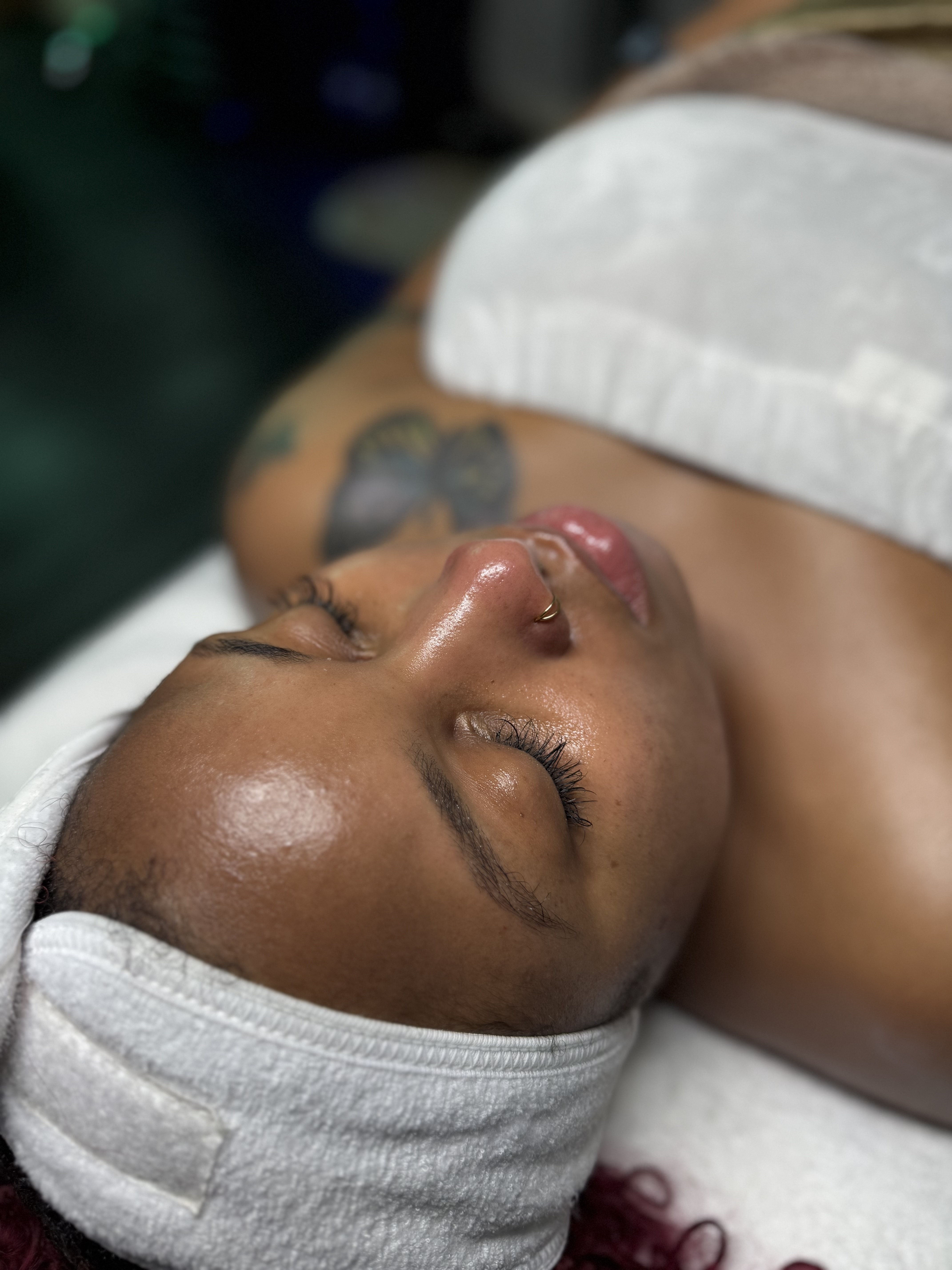 Chemical Peel Treatment