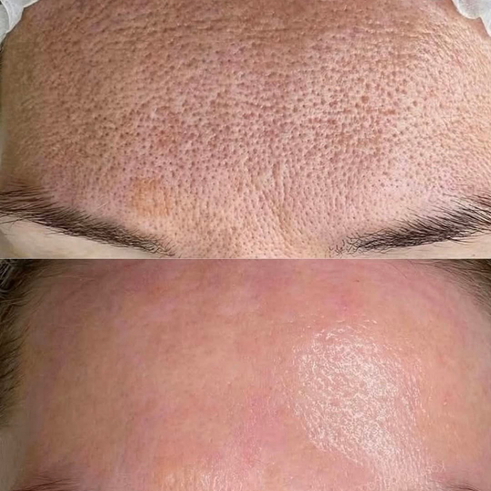 Nanoneedling With WildBerry Facial at Bella Shell Spa in Spring Branch, TX