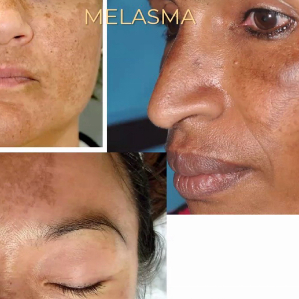 Hyperpigmentation Treatment (4) at Fountain of Youth Spa in Yuma, AZ