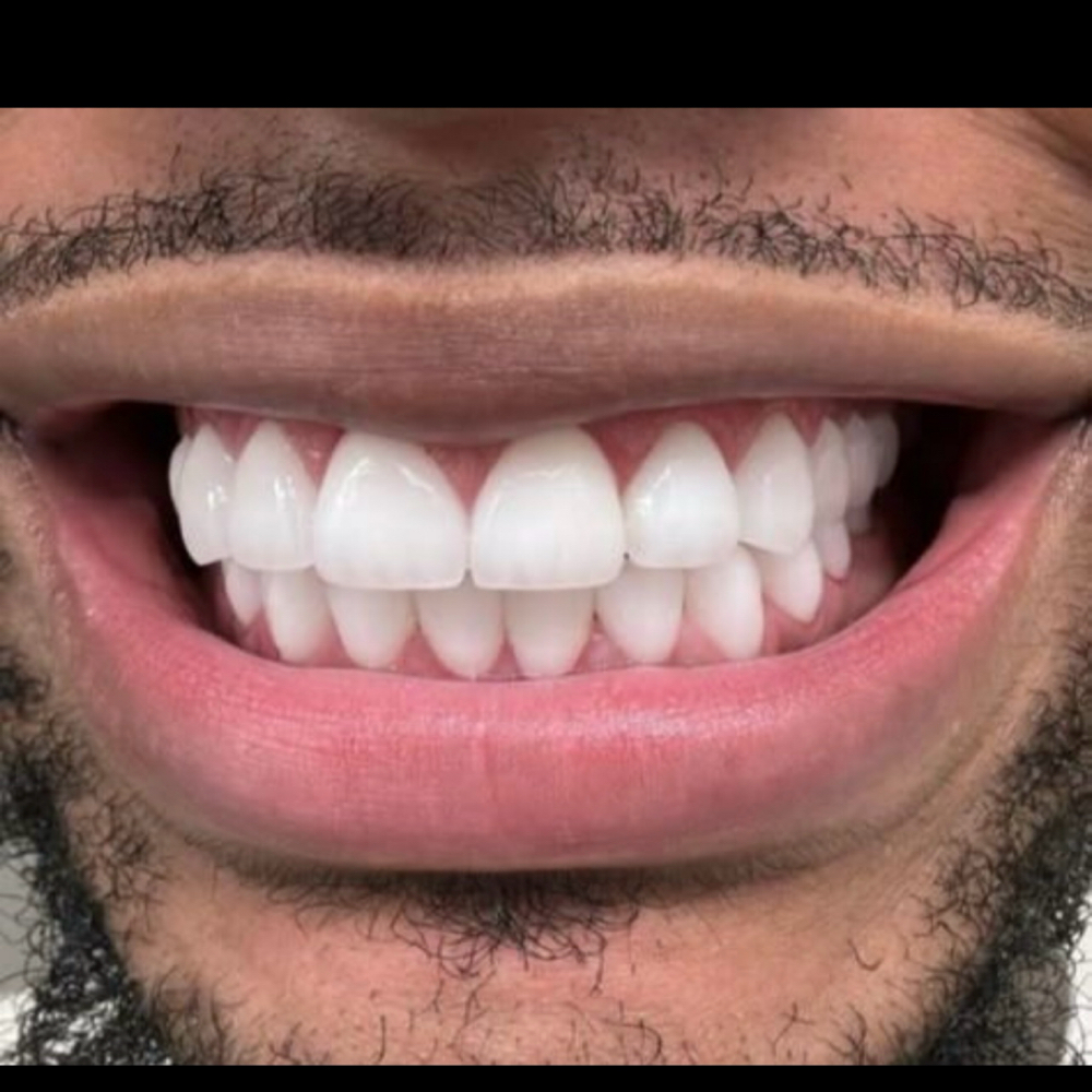 Teeth Whitening Option:1