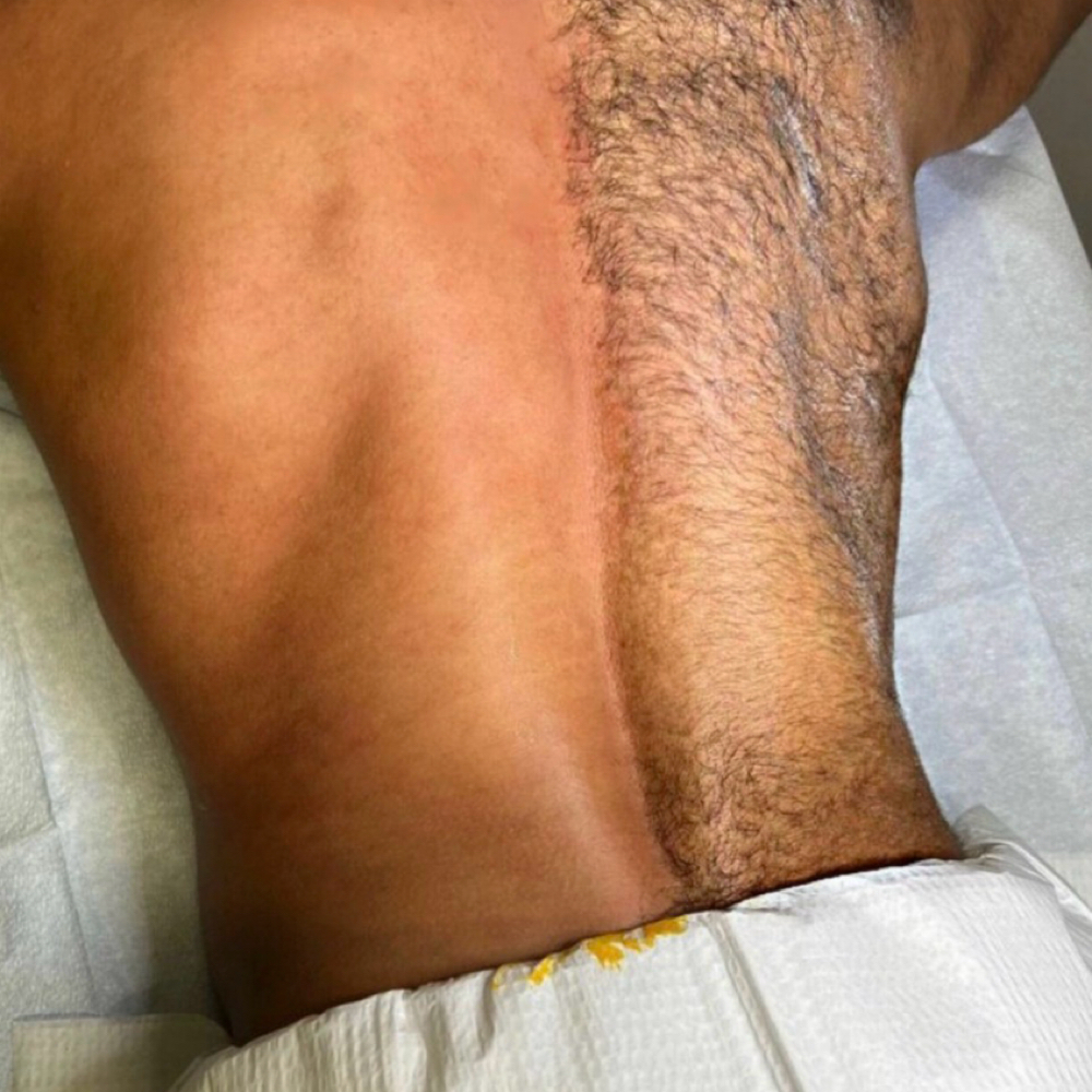 Back Wax at Revitalize Health in Florence, SC