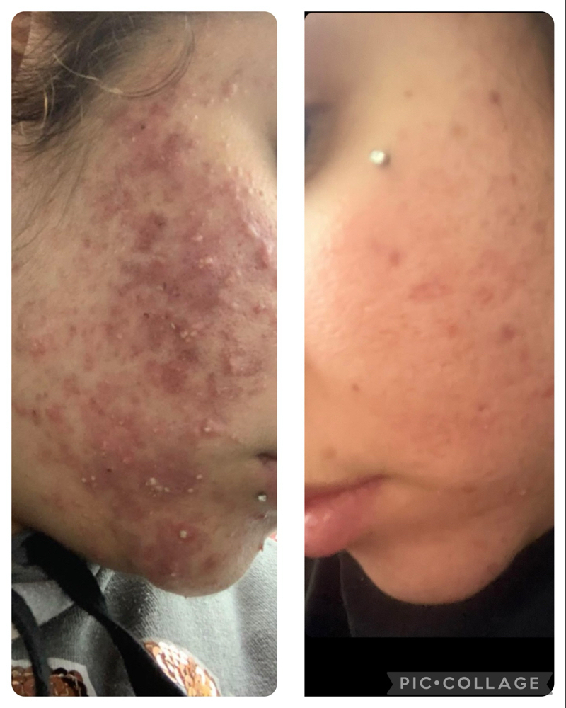 Acne Facial