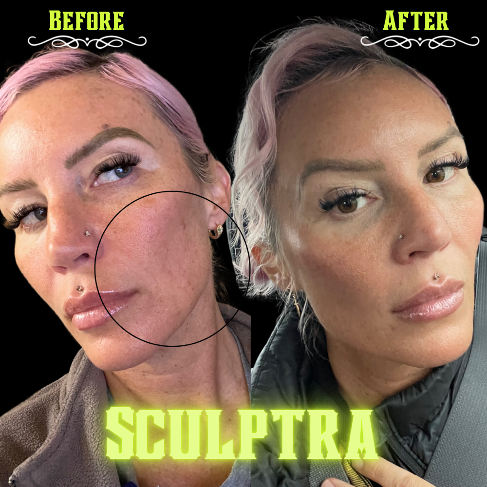 Sculptra