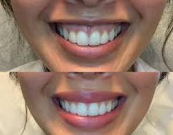 Established Patient- Lip Flip