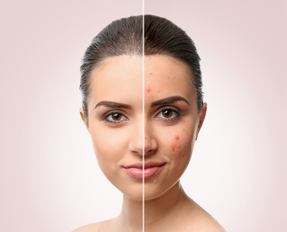 Acne Facial