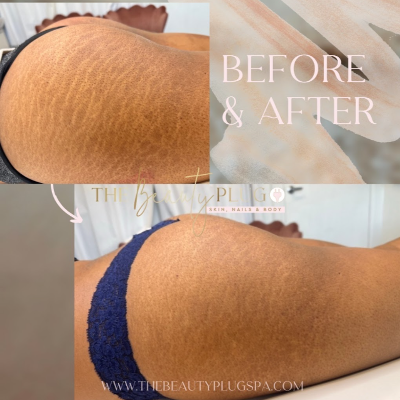 Inkless Stretch Mark Reduction at Brow Chica Brow Bar in Warner Robins, GA