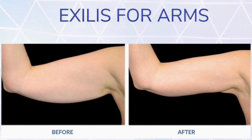 Exilis Arms Pkg Of 6(upper & Lower)