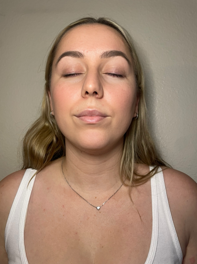Fat Dissolve Chin.