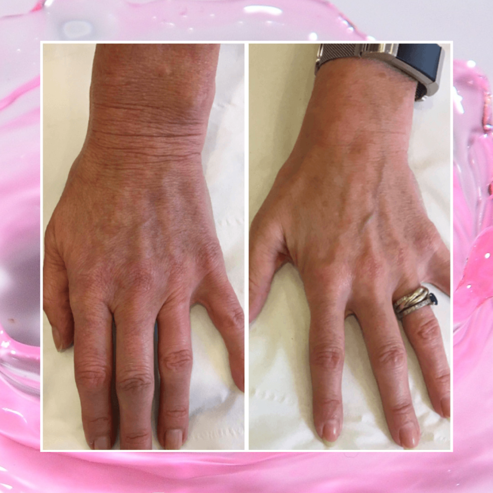 Hand Rejuvenation