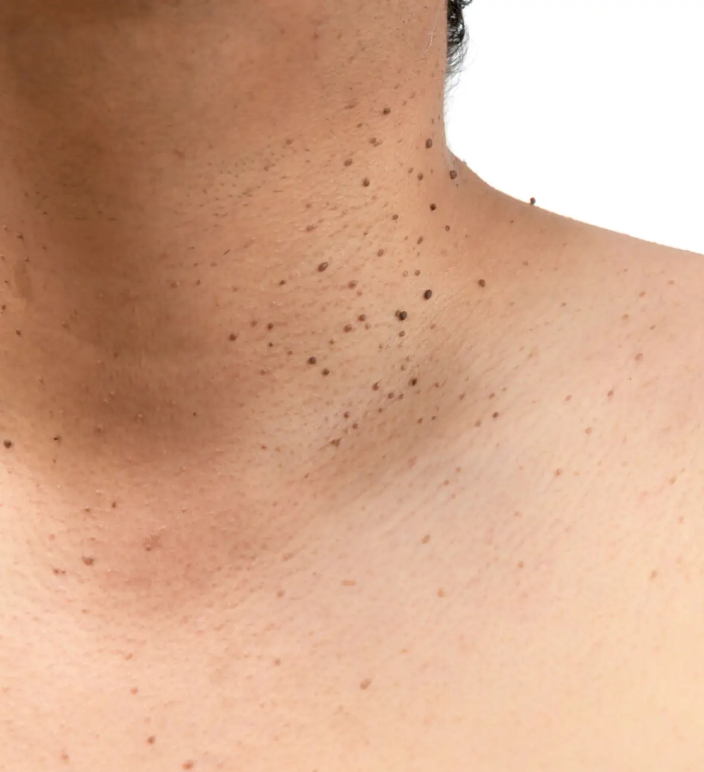 Skin Irregularity Removal