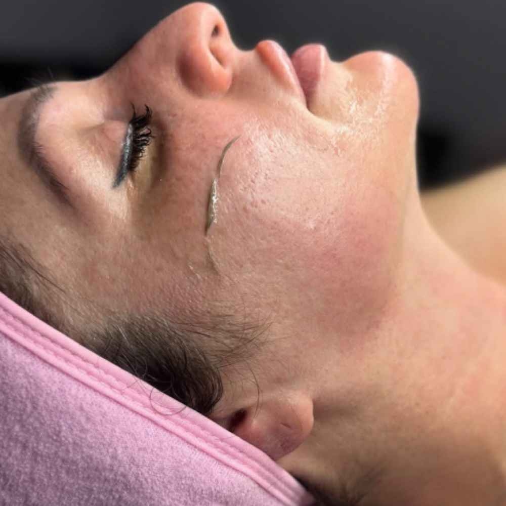 Dermaplane Only at MLN Esthetics in West Springfield, MA