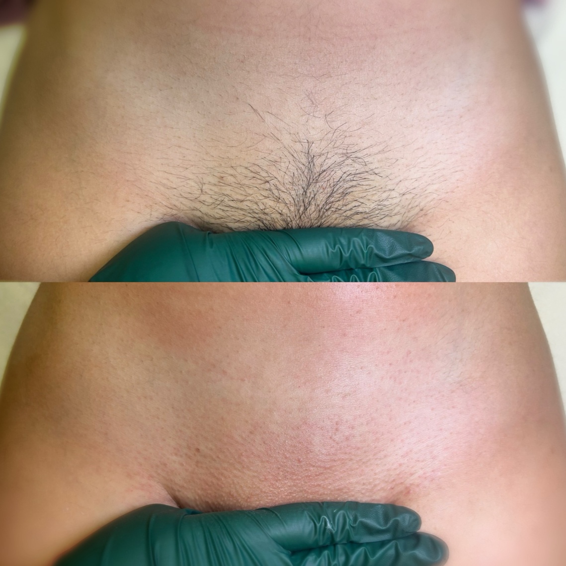Brazilian + Underarm at Waxed By Chloe in Smyrna, TN