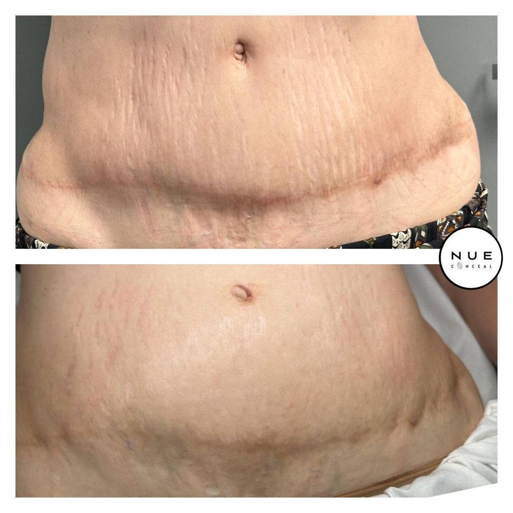 Inkless/Camo Tummy Tuck Scar 180