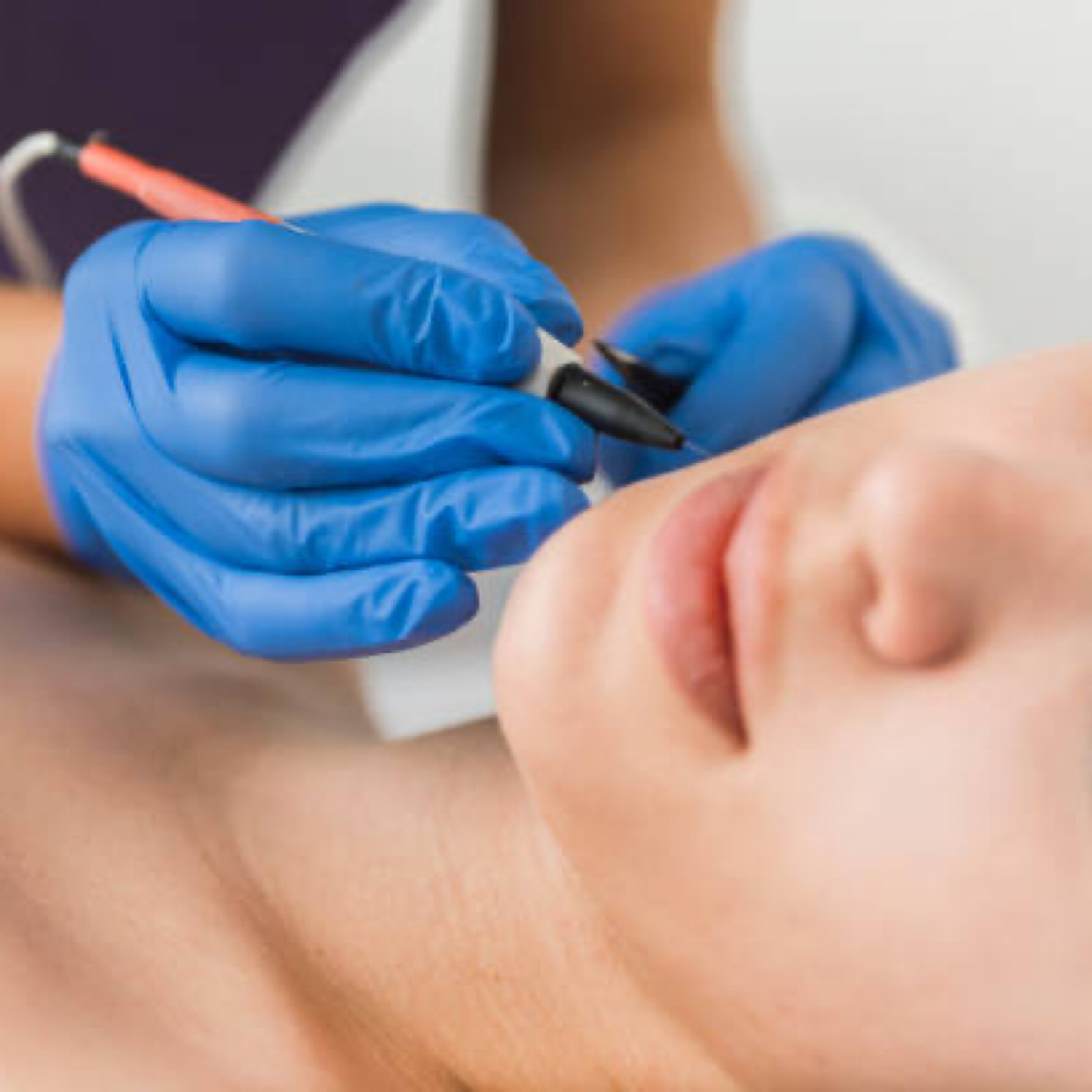 15 Minute Electrolysis Session at Snatched Waxing & Aesthetics in Denver, CO