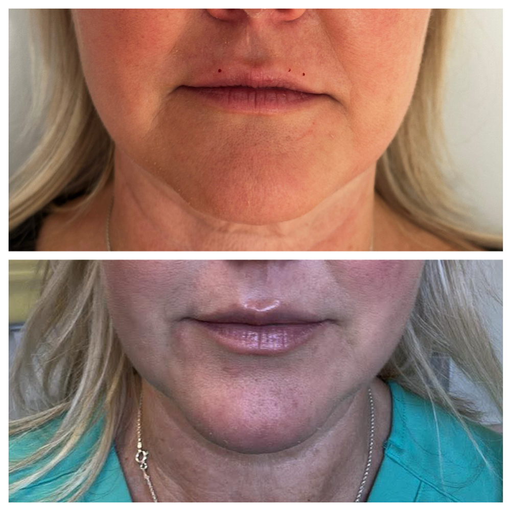 Lip Flip at SCL Aesthetics in Putnam, CT