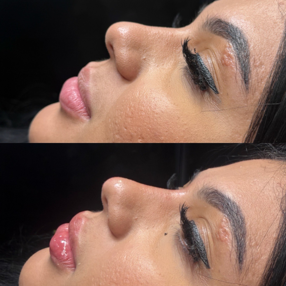 Nose Filler at Maurika Beauty in Jacksonville, FL