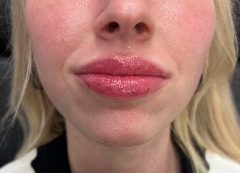 Lip Filler- Full Syringe of LIPS+