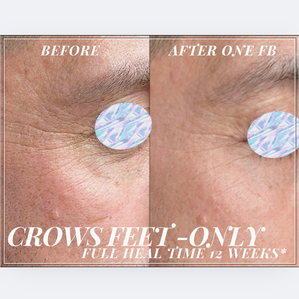 Crows Feet (only)