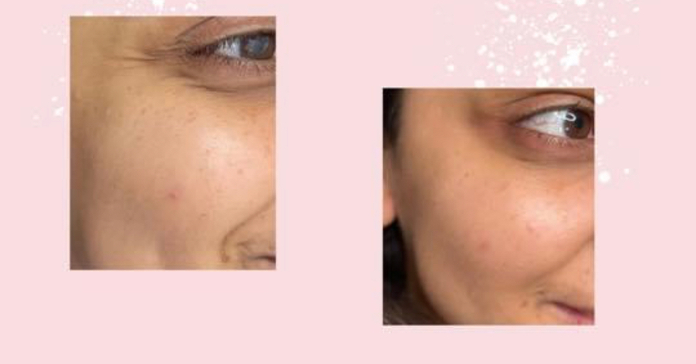 Botox (crows Feet)