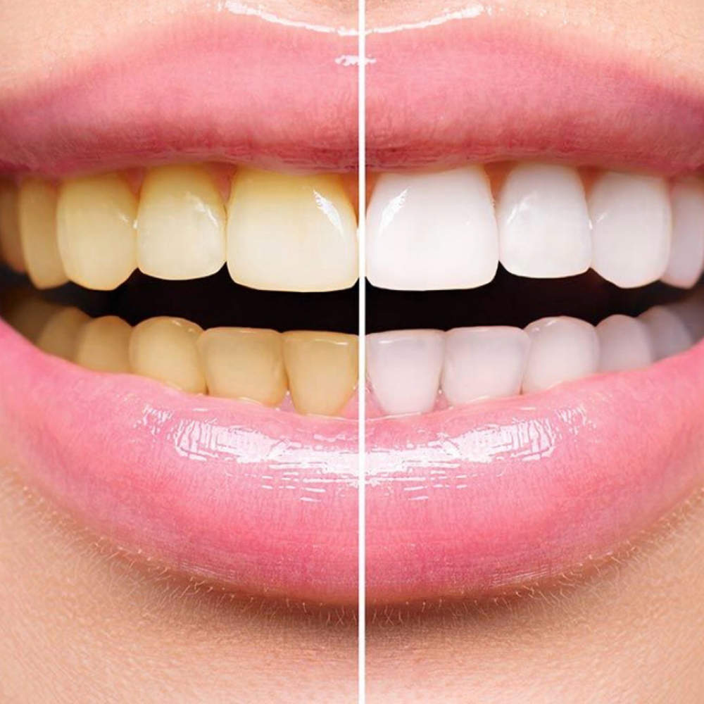Teeth Whitening at LALISLASHES LLC in Bridgeport, CT