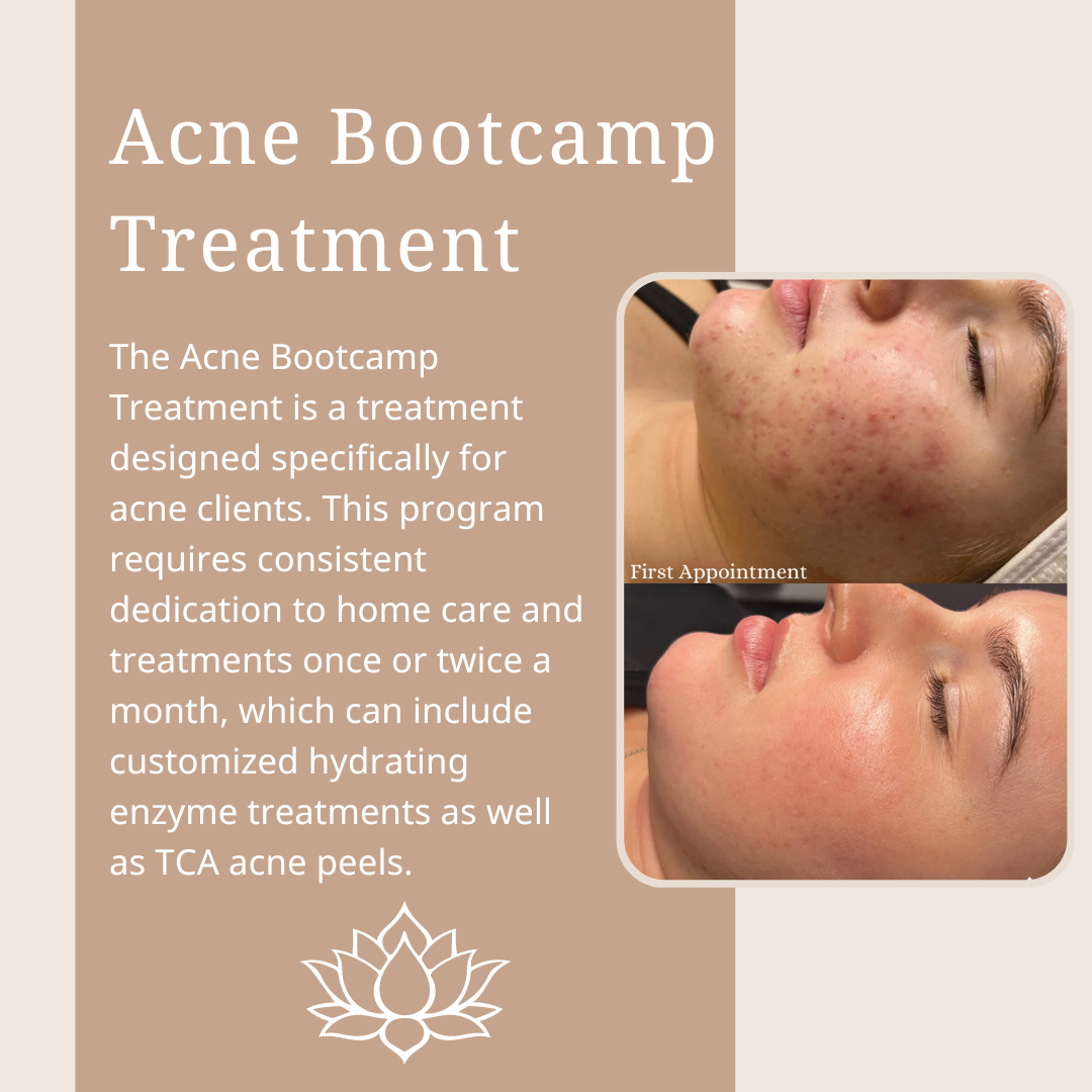 Acne Peel