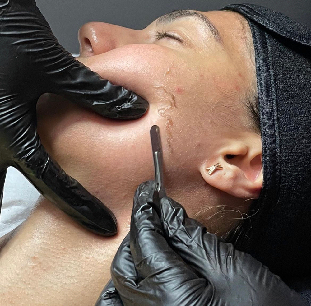Dermaplanning Facial