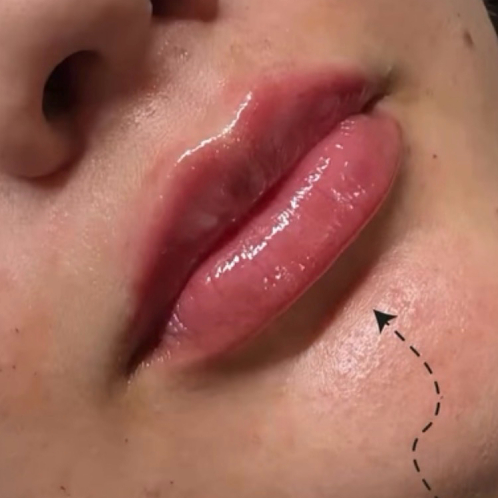 .5 ML Lip Filler at Balance.Bar.Aesthetics in Berkeley, CA