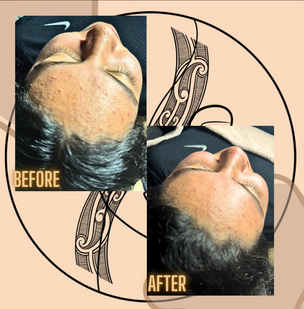 High Frequency Facial at Mana Aesthetics in Las Vegas, NV