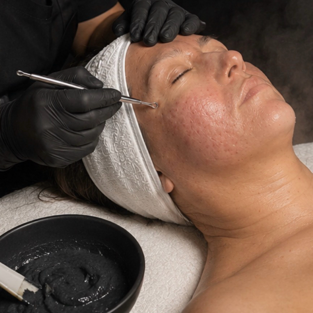 CYNN’S Acne Recovery Facial at CYNNSBEAUTY in Orange, CA
