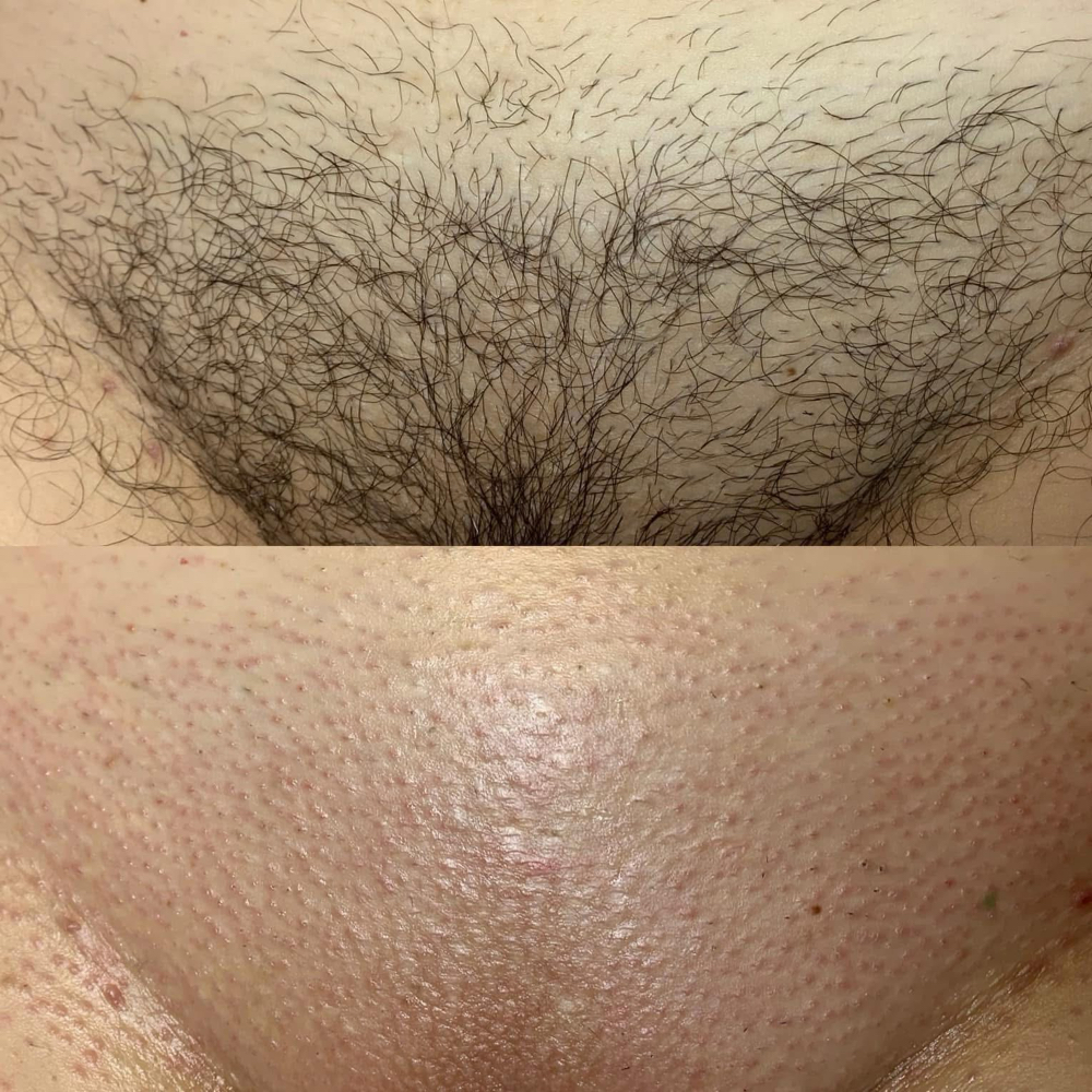BRAZILIAN WAX