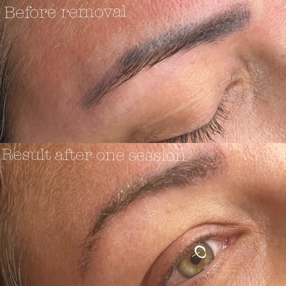 TATTOO REMOVAL (Eyebrows)