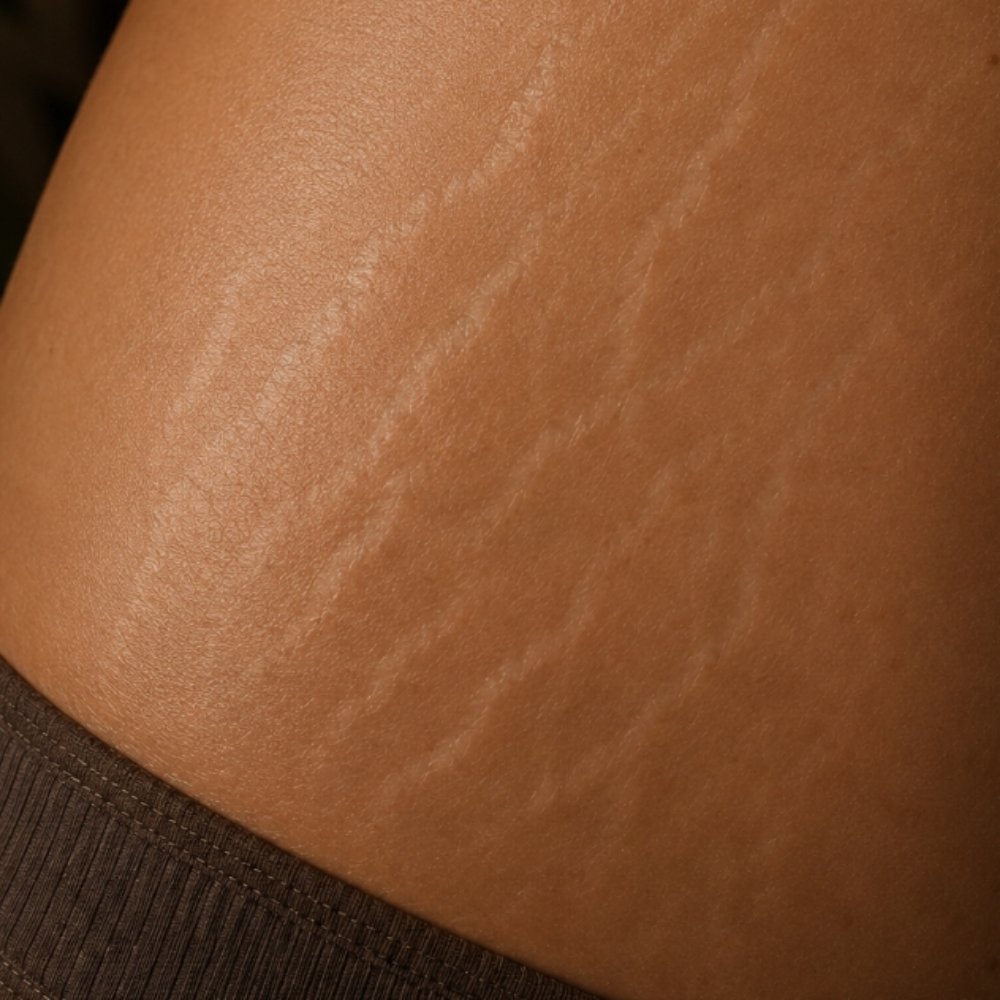 Inkless Skin Revision at Suede Studios in Georgetown, TX