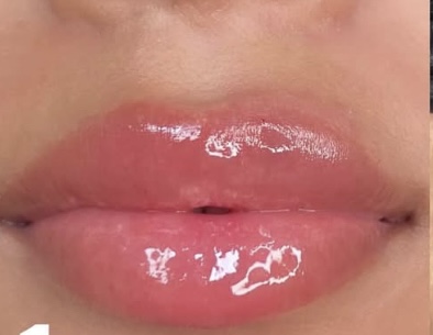 Lip Filler