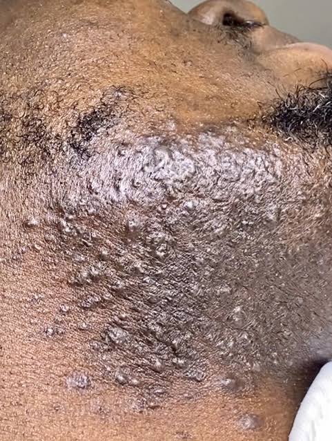 Ingrown Beard Treatment