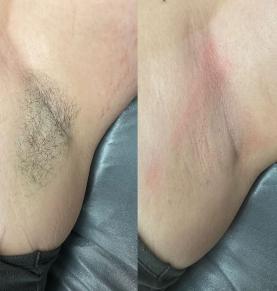 Under Arm Wax