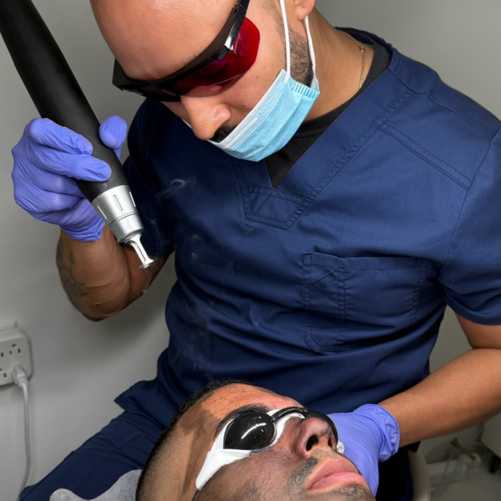 Carbon Peel Laser