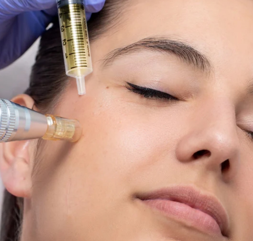 Microneedling Facial