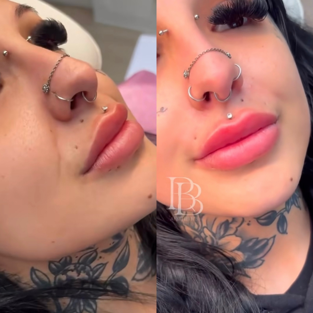 Nasolabial Folds at Balance.Bar.Aesthetics in Berkeley, CA