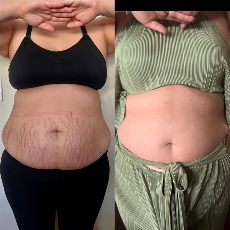 3 Area Stretch Mark CoverUP Package at Cosmetic Studio 54 in Los Angeles, CA