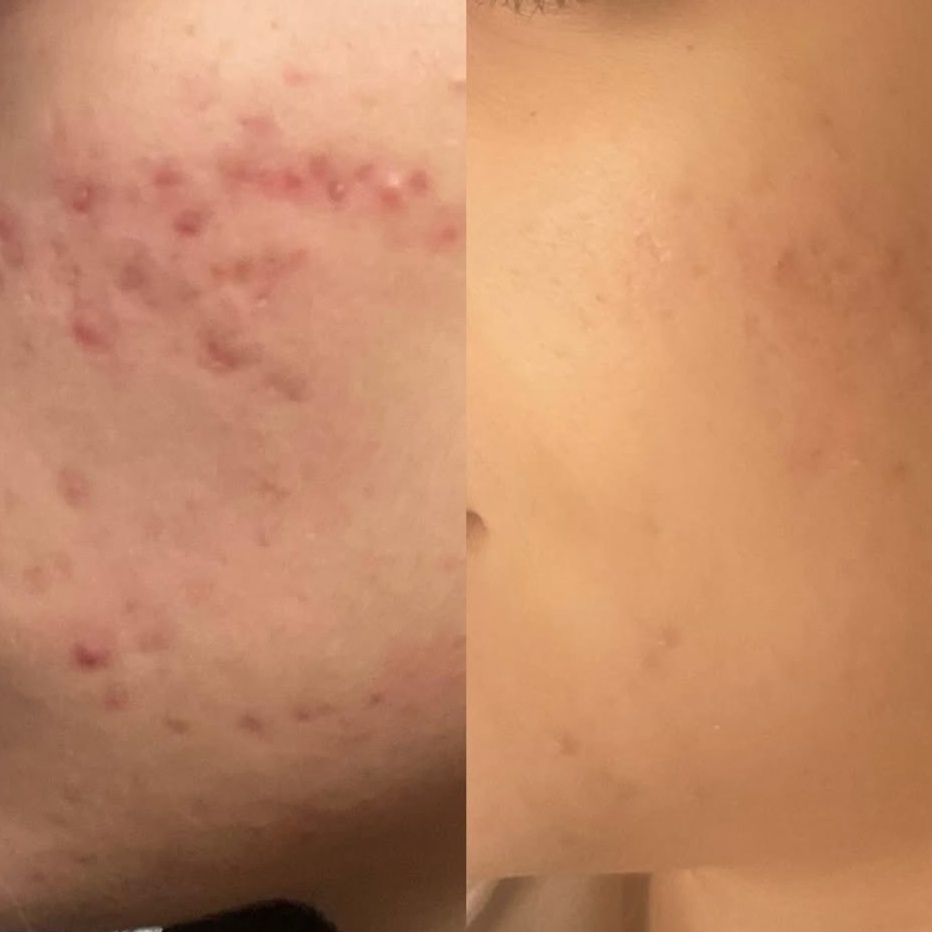 Acne Treatment at Skin Savvy Solutions | Corrective Skin Care | Facials in Hallandale Beach, FL