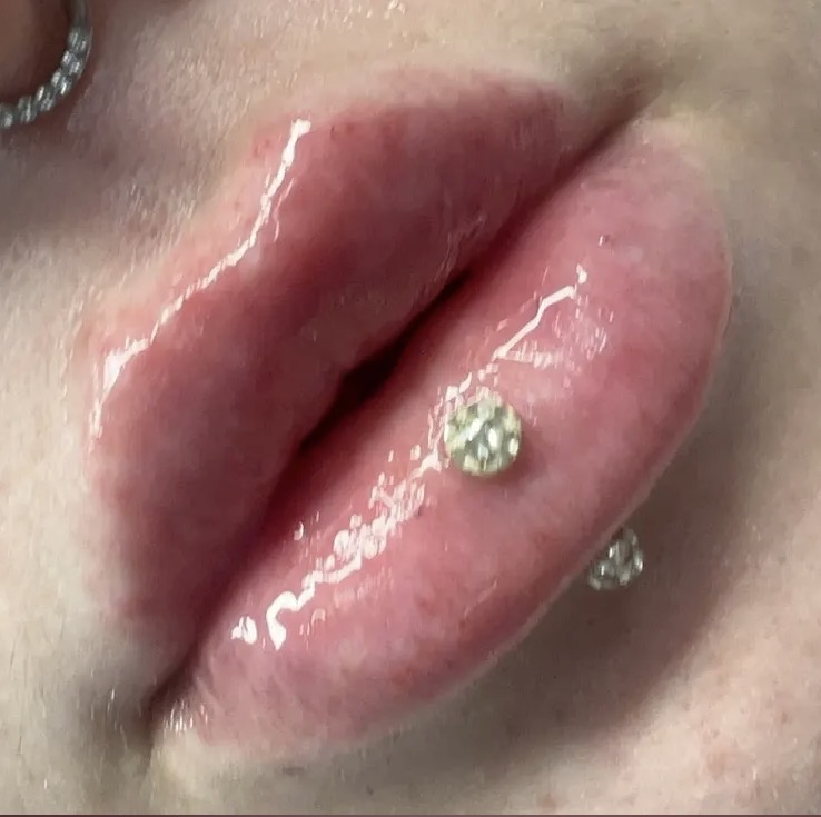 HYALURON PEN at Lux Skincare in Phoenix, AZ