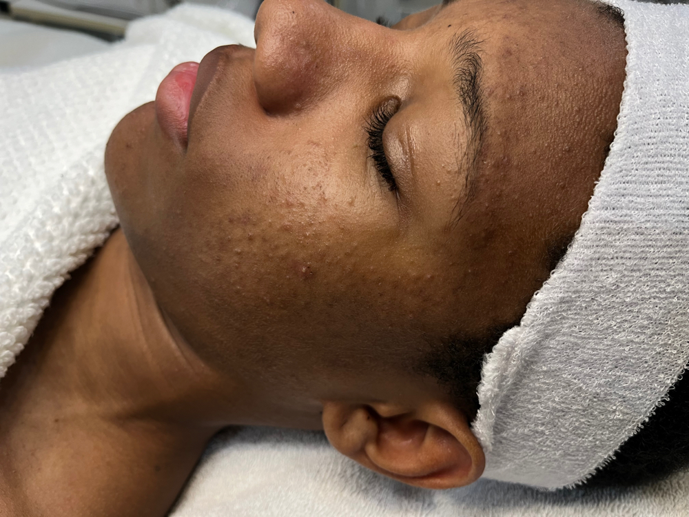 Teen Acne Facial