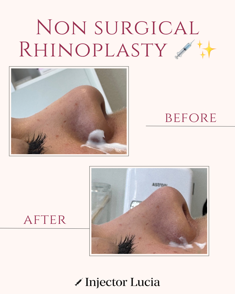 Liquid Rhinoplasty
